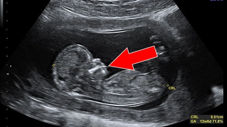 Beim Ultraschall Erfährt Eine Junge Amerikanerin Dass Ihr Baby.