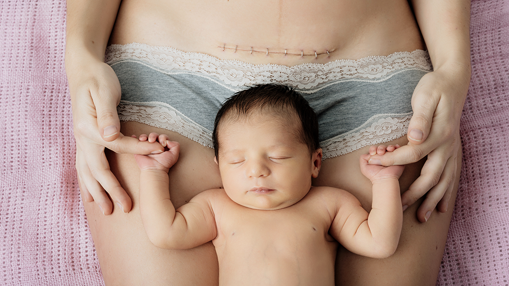 50+ Bauch nach kaiserschnitt bilder , Nach Notkaiserschnitt entwickelt sich etwas Seltsames im Bauch der Mutter